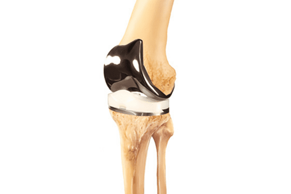 Joint replacement