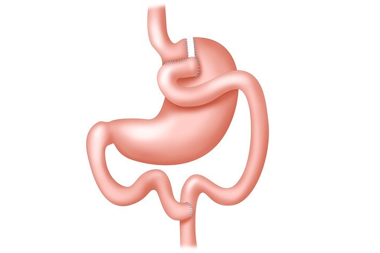 Бариатрическая операция. Желудочное шунтирование (gastric Bypass). Бариатрическая операция шунтирование желудка. Лапароскопическое гастрошунтирование (gastric-Bypass)..